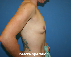 plastic-surgery-breast-augmentation
